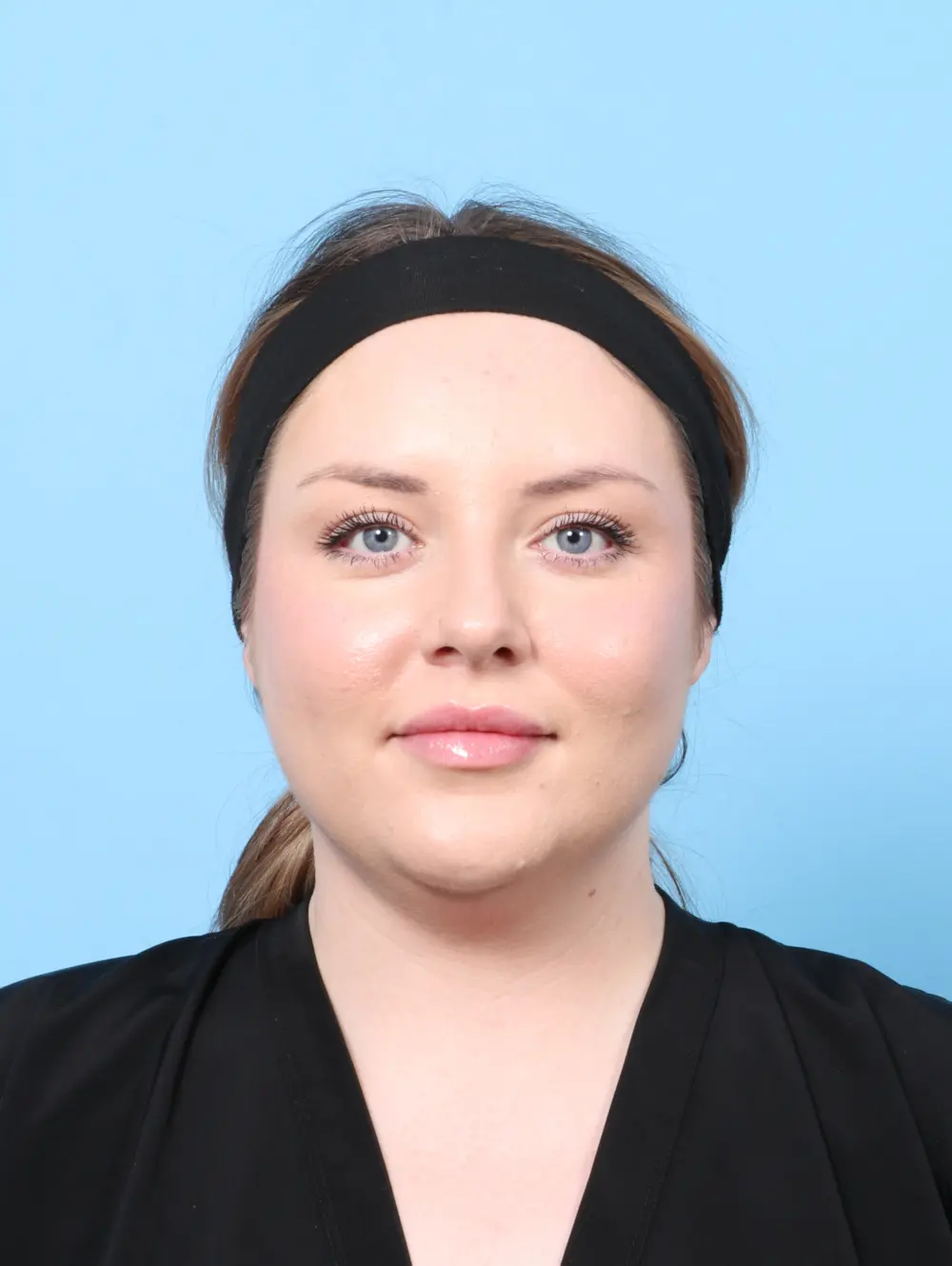 Submental Liposuction Patient Photo - Case 61522 - before view-2