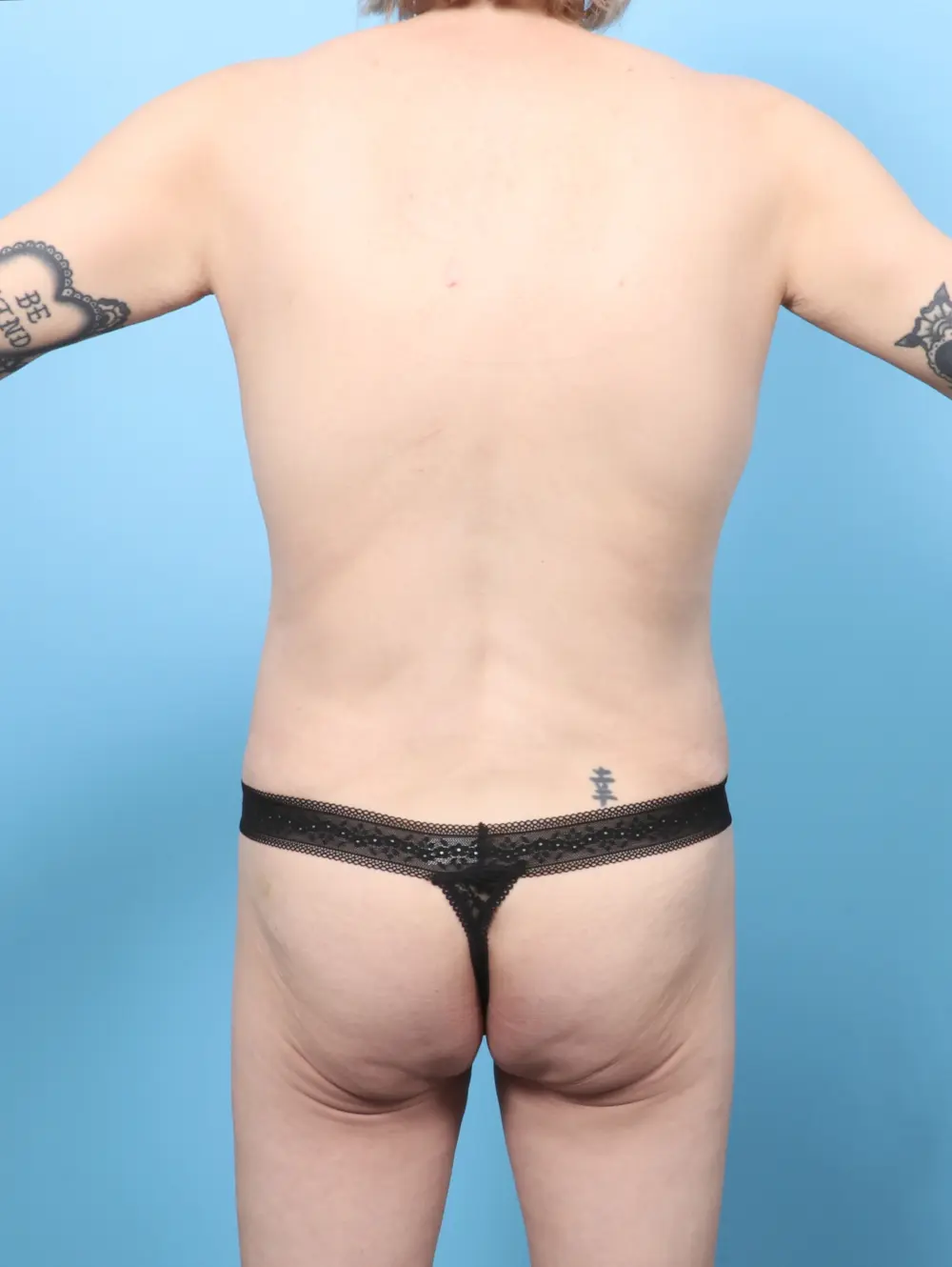 Breast Lift/Reduction w/o Implants Patient Photo - Case 61547 - after view-3