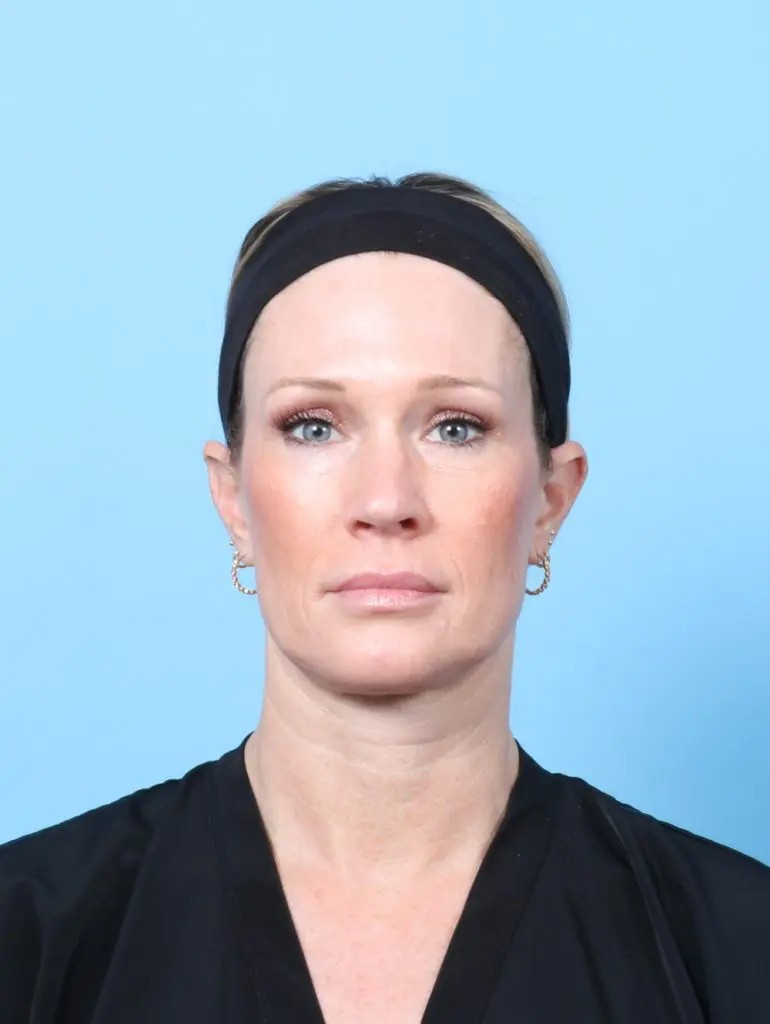 Eyelid Surgery - Case 61557 - After