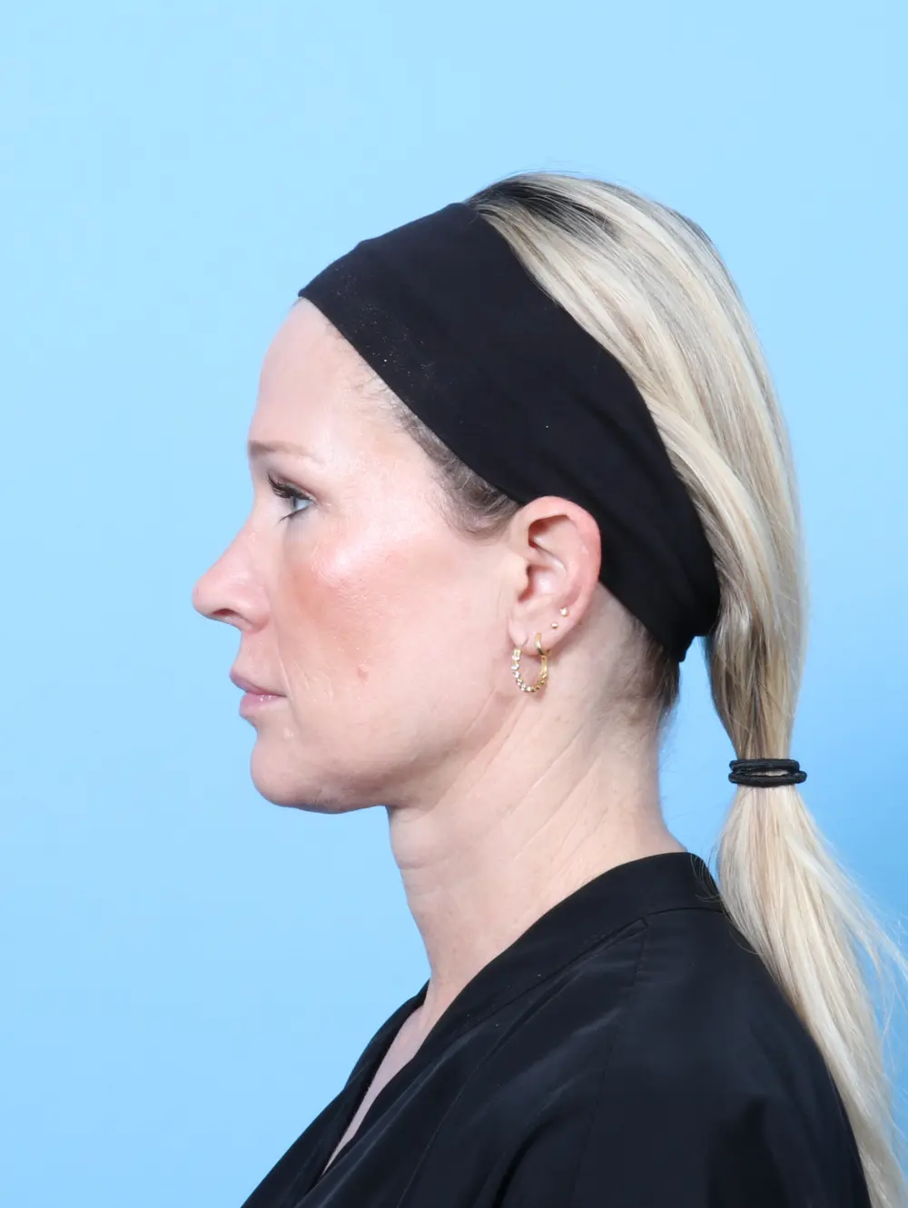 Eyelid Surgery Patient Photo - Case 61557 - after view-2