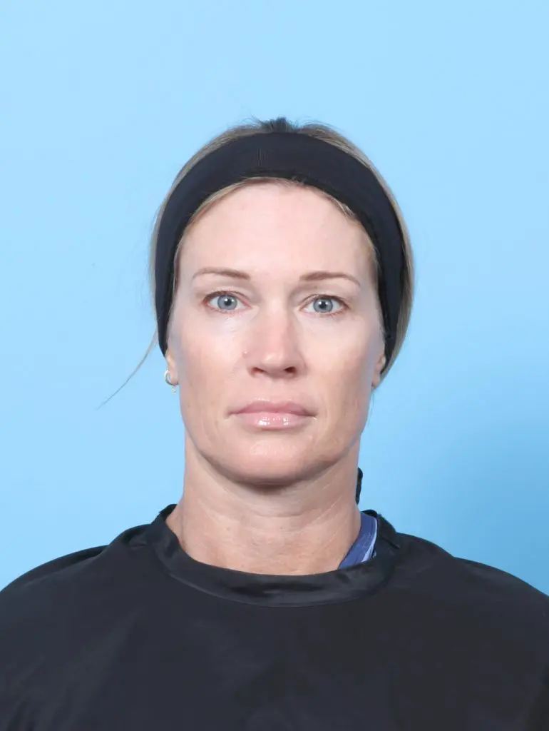 Eyelid Surgery - Case 61557 - Before