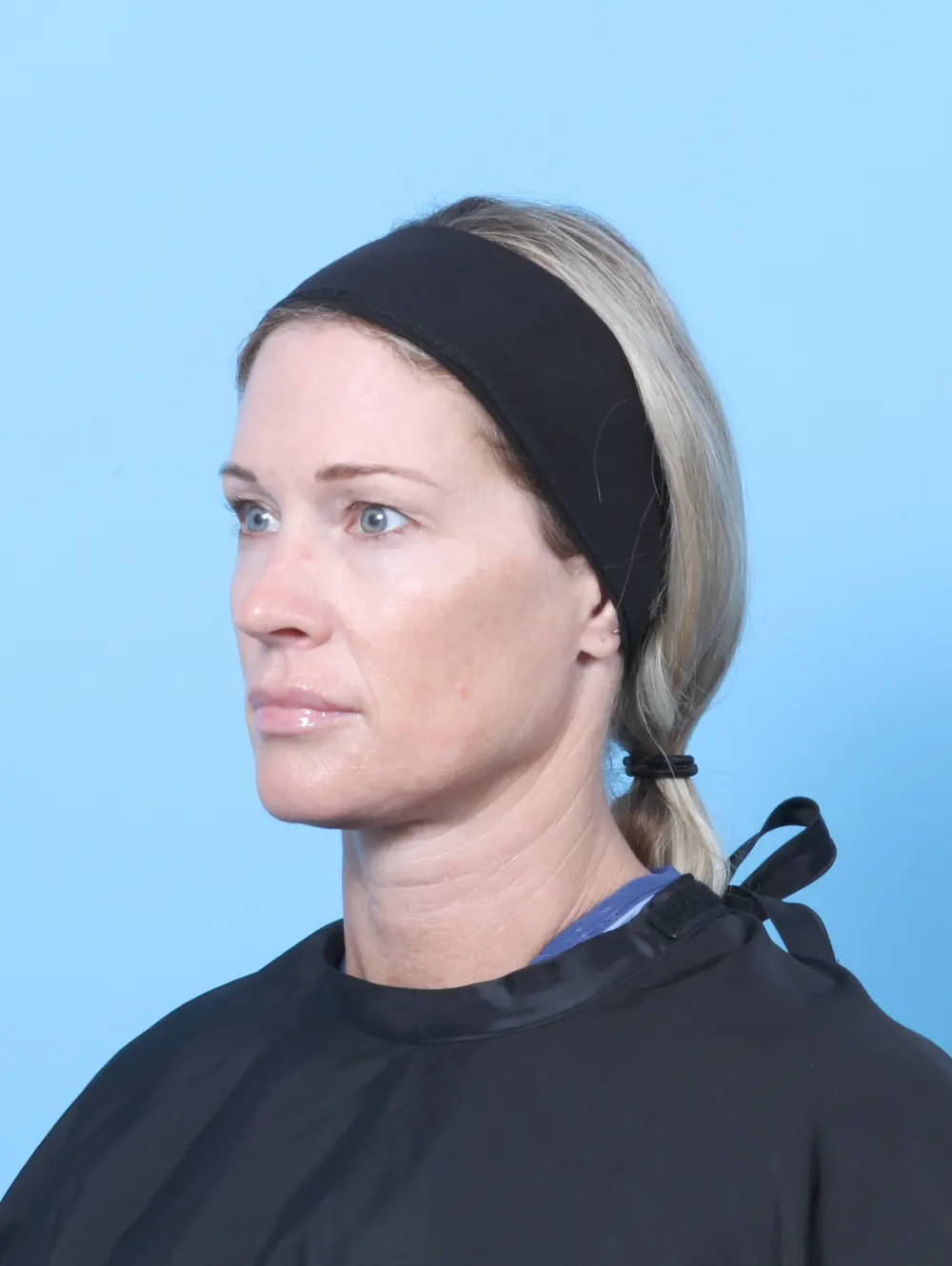 Eyelid Surgery Patient Photo - Case 61557 - before view-1