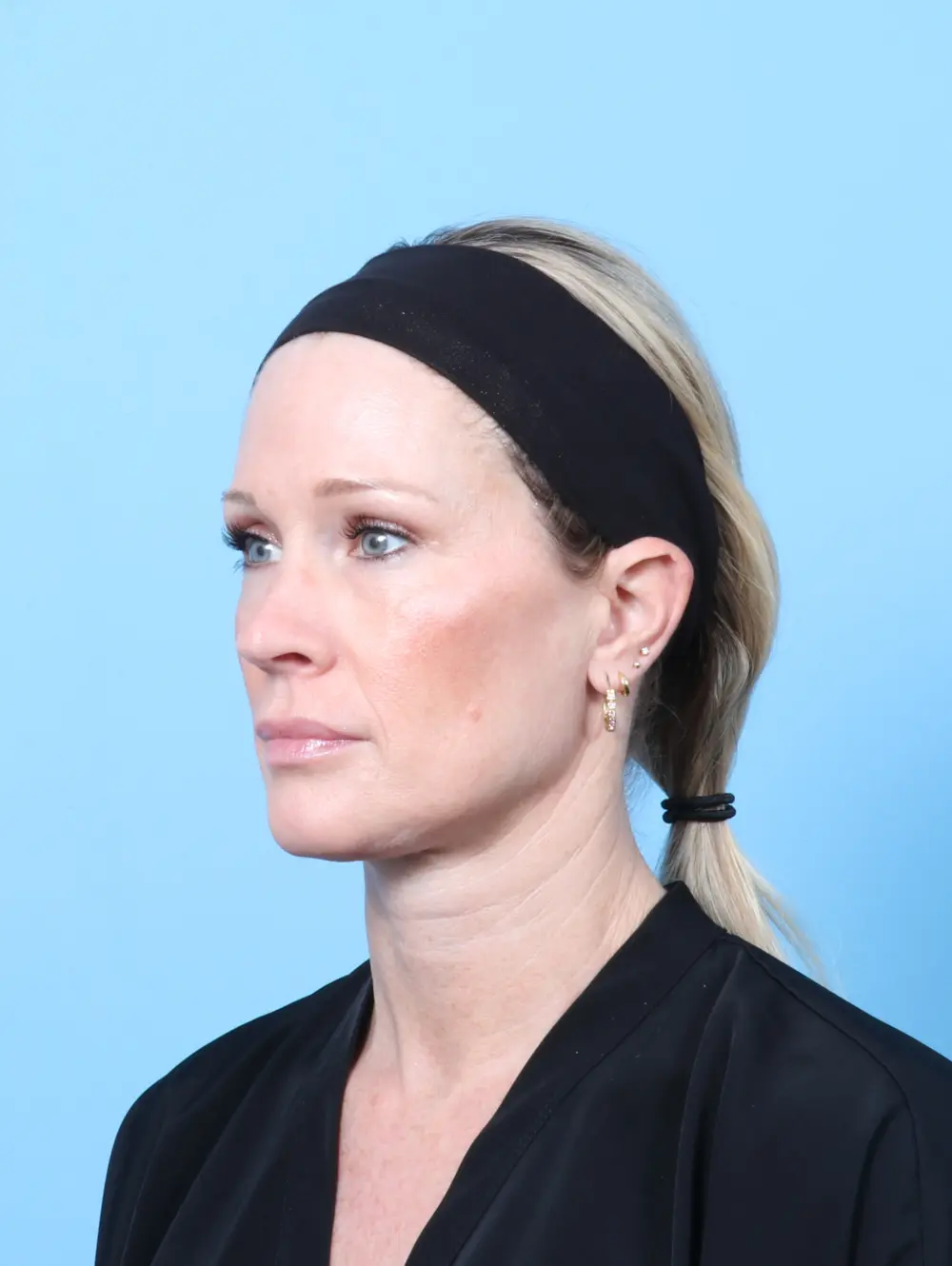 Eyelid Surgery Patient Photo - Case 61557 - after view-1
