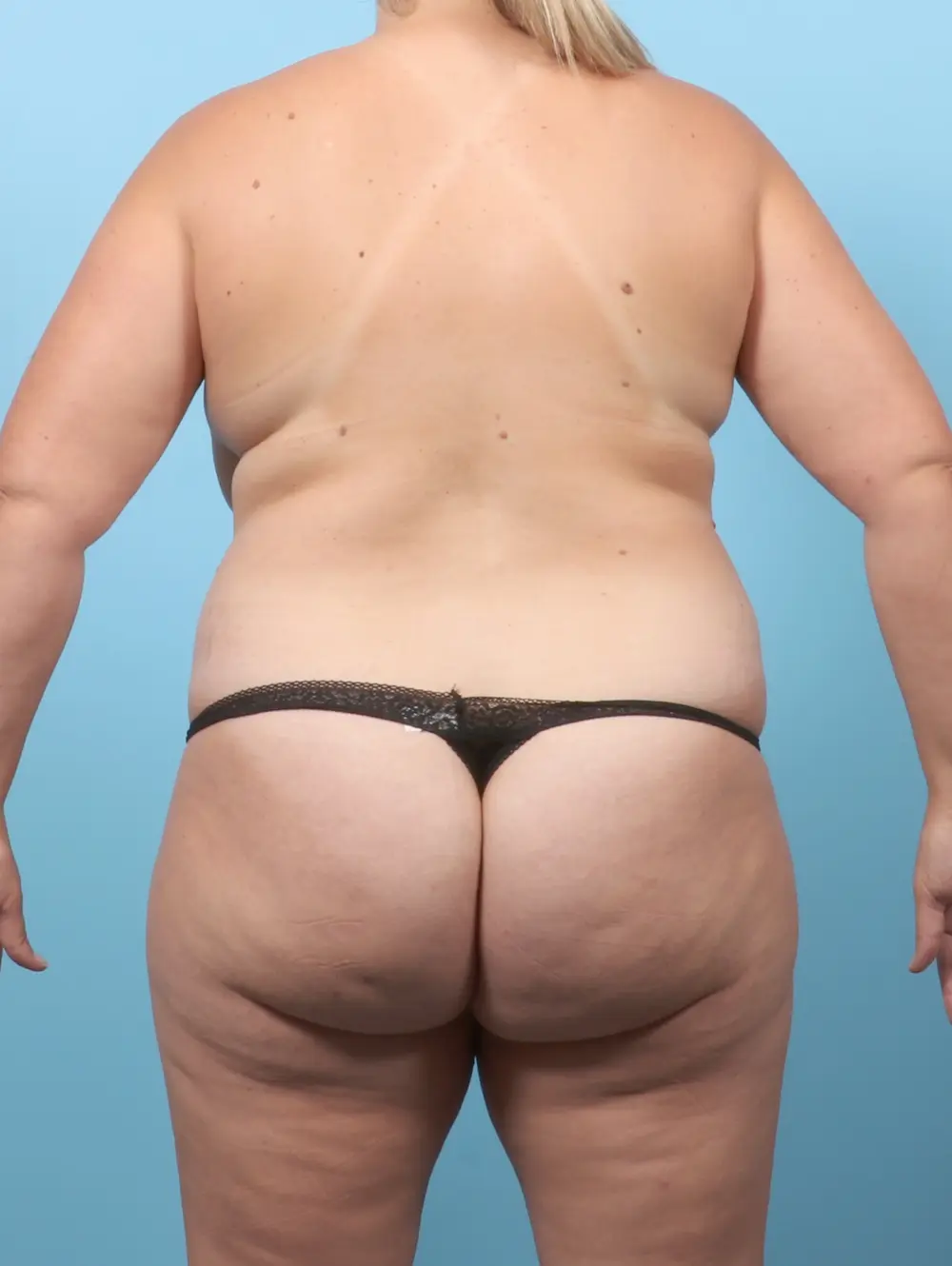 Breast Lift/Reduction w/o Implants Patient Photo - Case 61581 - before view-3