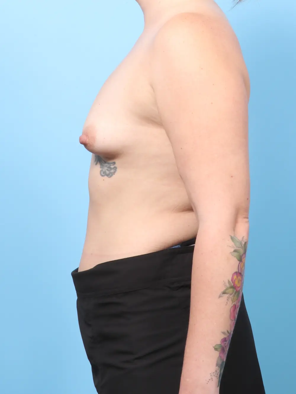 Breast Augmentation Patient Photo - Case 61599 - before view-2