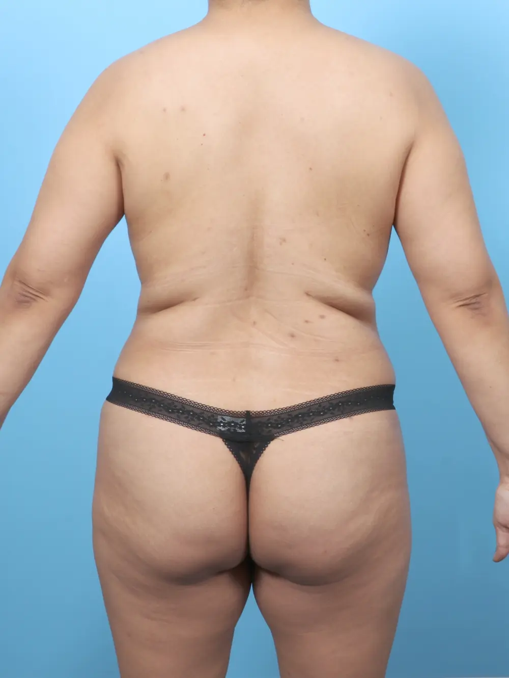 Breast Lift/Reduction with Implants Patient Photo - Case 61607 - after view-3