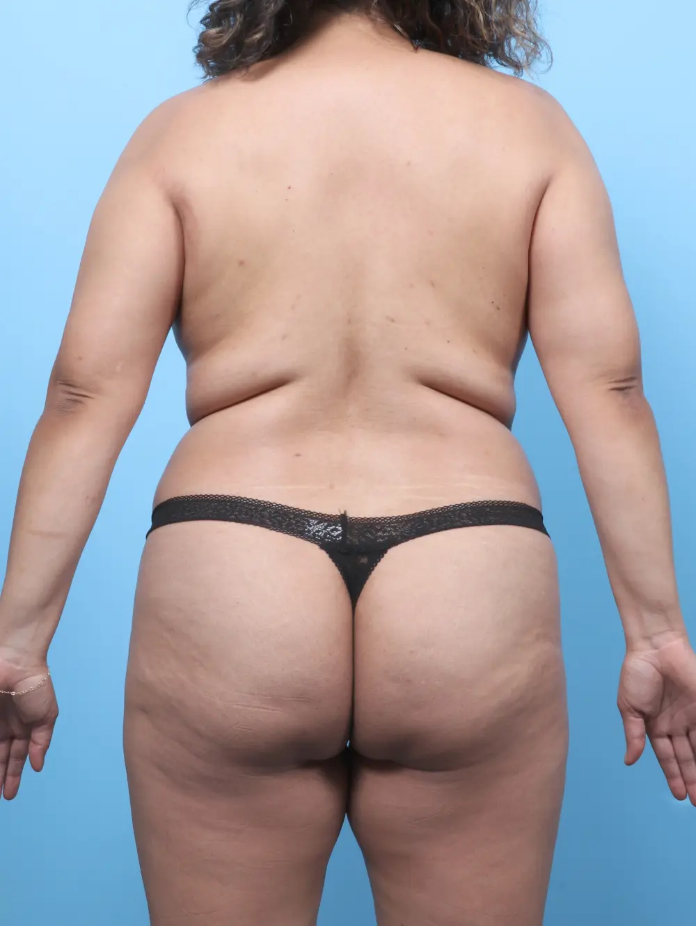 Breast Lift/Reduction with Implants Patient Photo - Case 61607 - before view-3