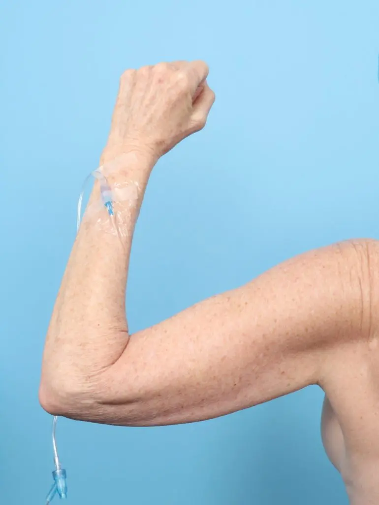 Arm Lift - Case 61617 - Before