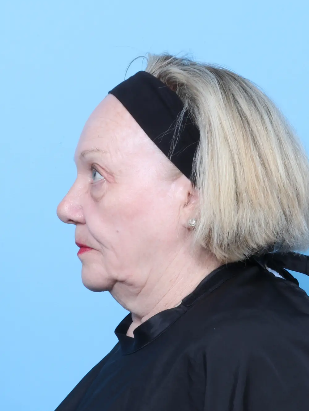 Eyelid Surgery Patient Photo - Case 61714 - before view-2