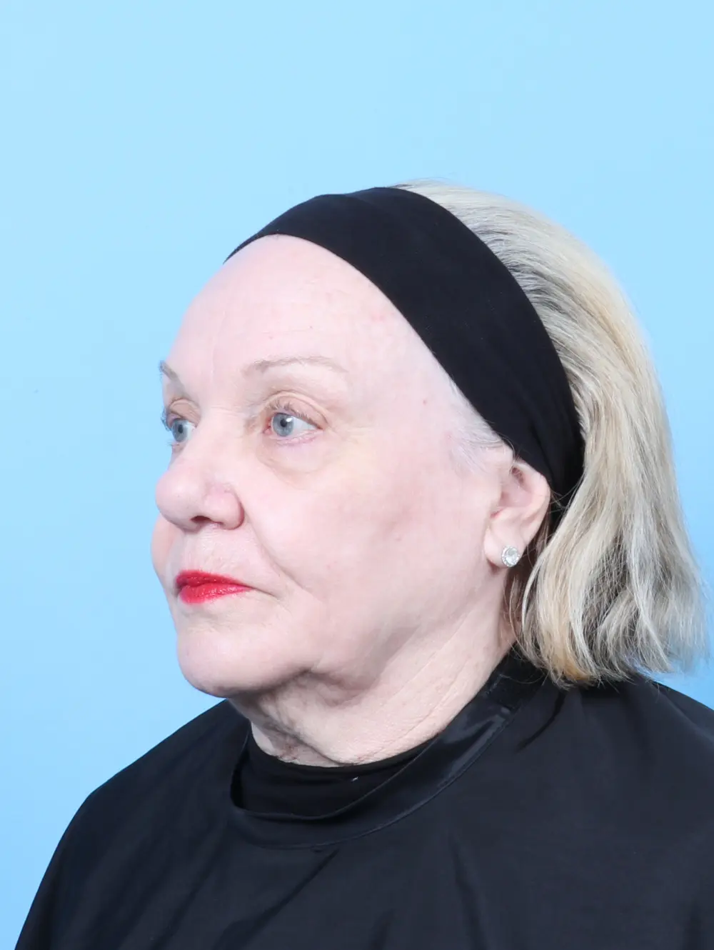 Eyelid Surgery Patient Photo - Case 61714 - after view-1