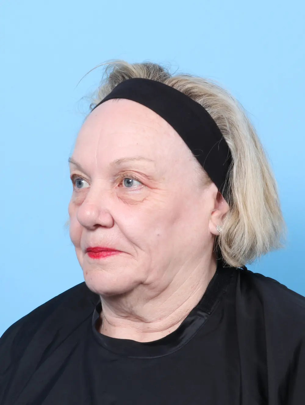 Eyelid Surgery Patient Photo - Case 61714 - before view-1