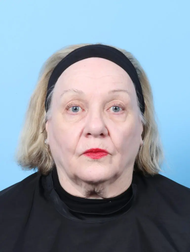Eyelid Surgery - Case 61714 - After