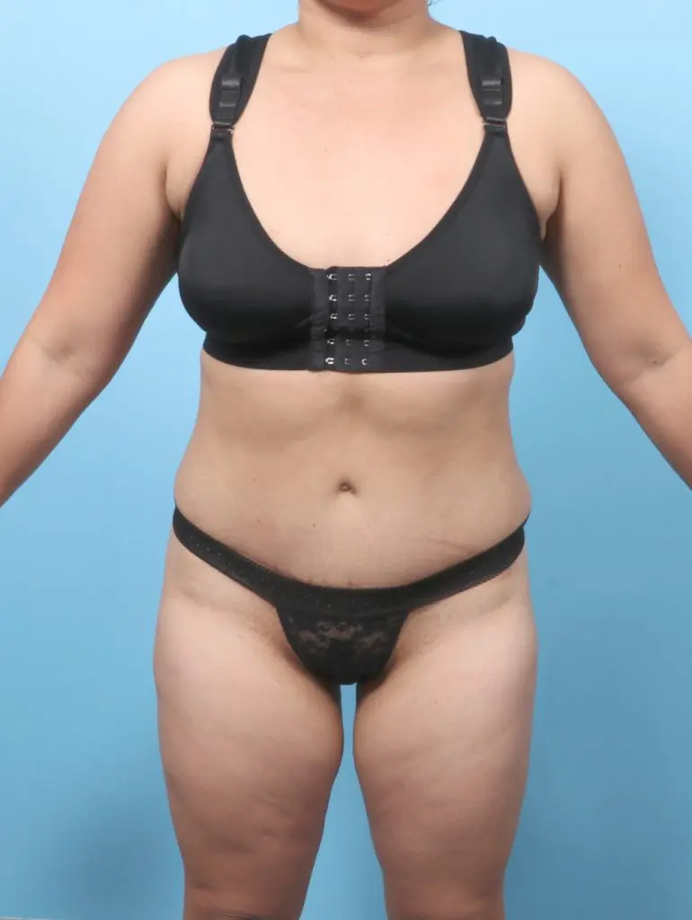 Tummy Tuck - Case 61757 - After