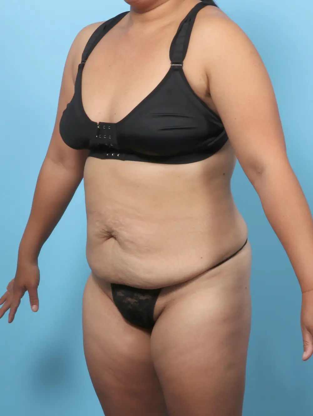 Tummy Tuck Patient Photo - Case 61757 - before view-1