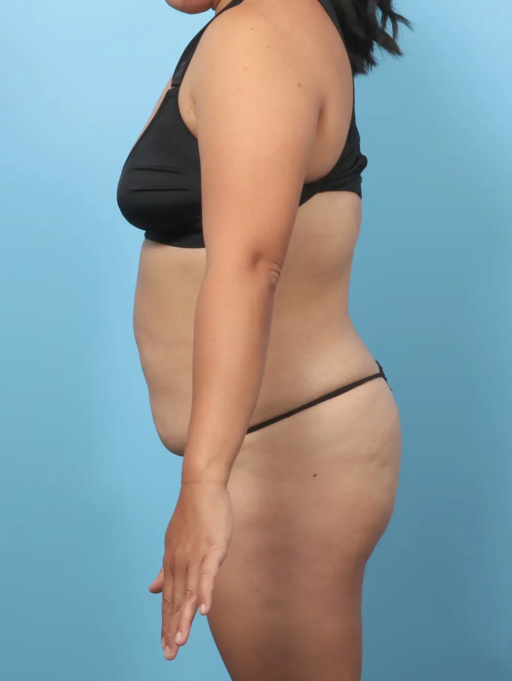 Tummy Tuck Patient Photo - Case 61757 - before view-2