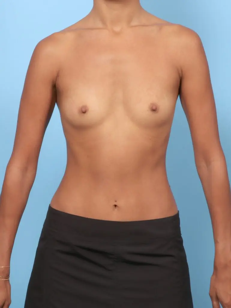 Breast Augmentation - Case 61765 - Before