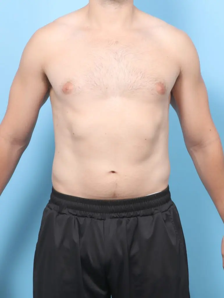 Gynecomastia - Case 61807 - Before