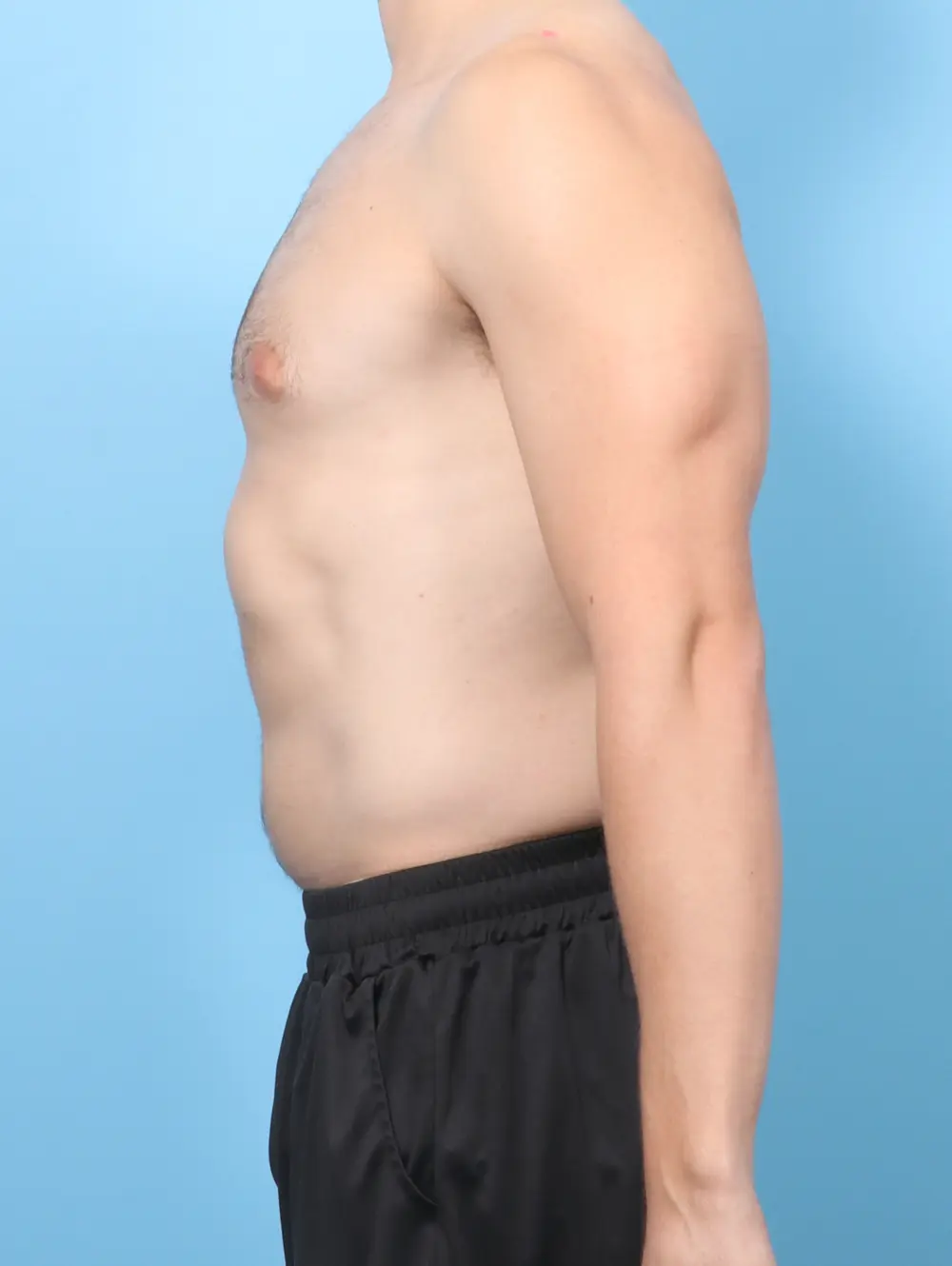 Gynecomastia Patient Photo - Case 61807 - before view-2
