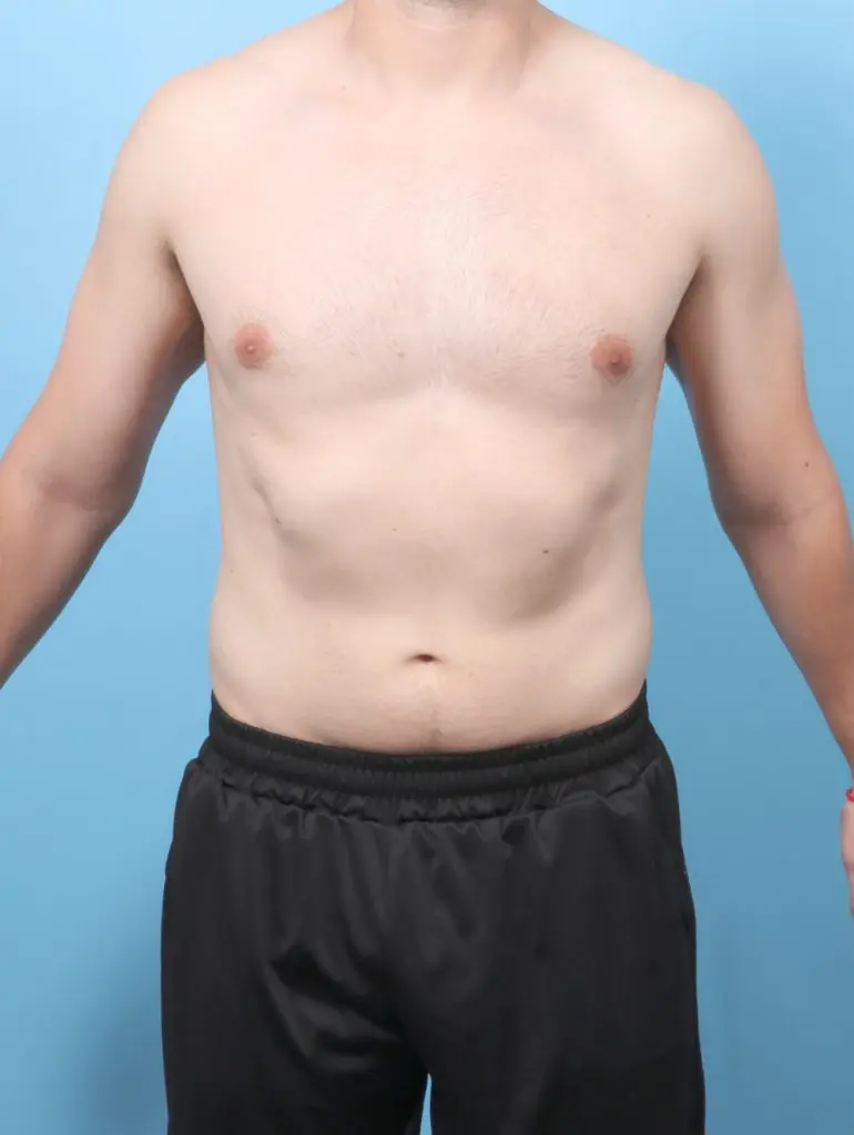 Gynecomastia - Case 61807 - After