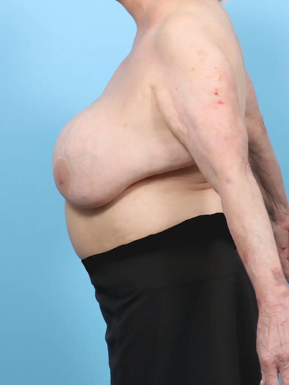 Breast Implant Removal Patient Photo - Case 61815 - before view-2