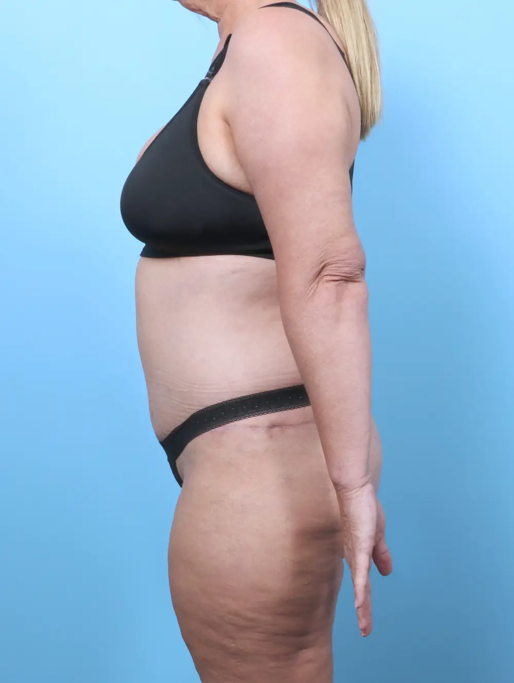 After Weight Loss Patient Photo - Case 61841 - after view-2