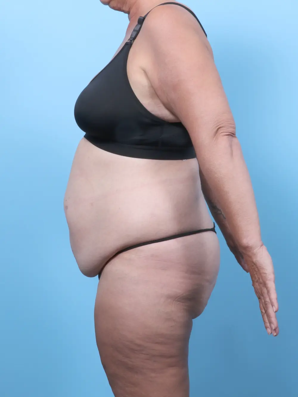 After Weight Loss Patient Photo - Case 61841 - before view-2