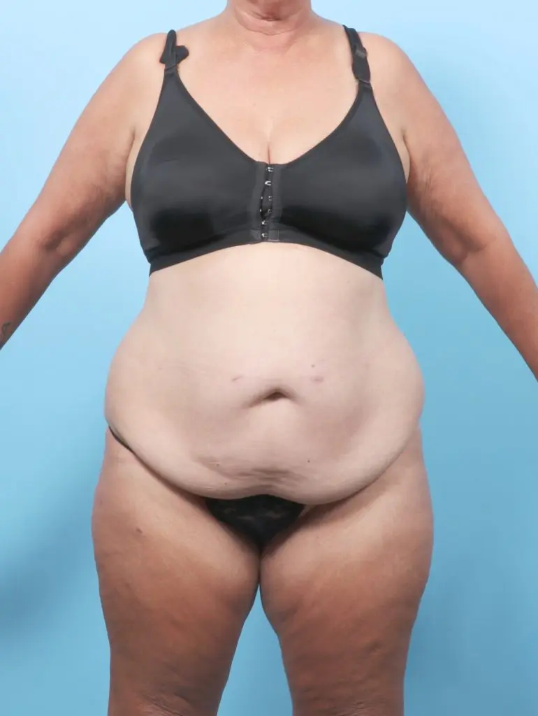After Weight Loss - Case 61841 - Before