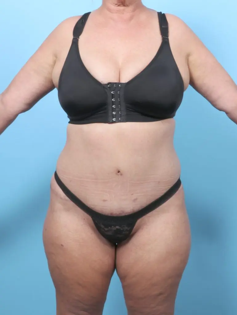 After Weight Loss - Case 61841 - After