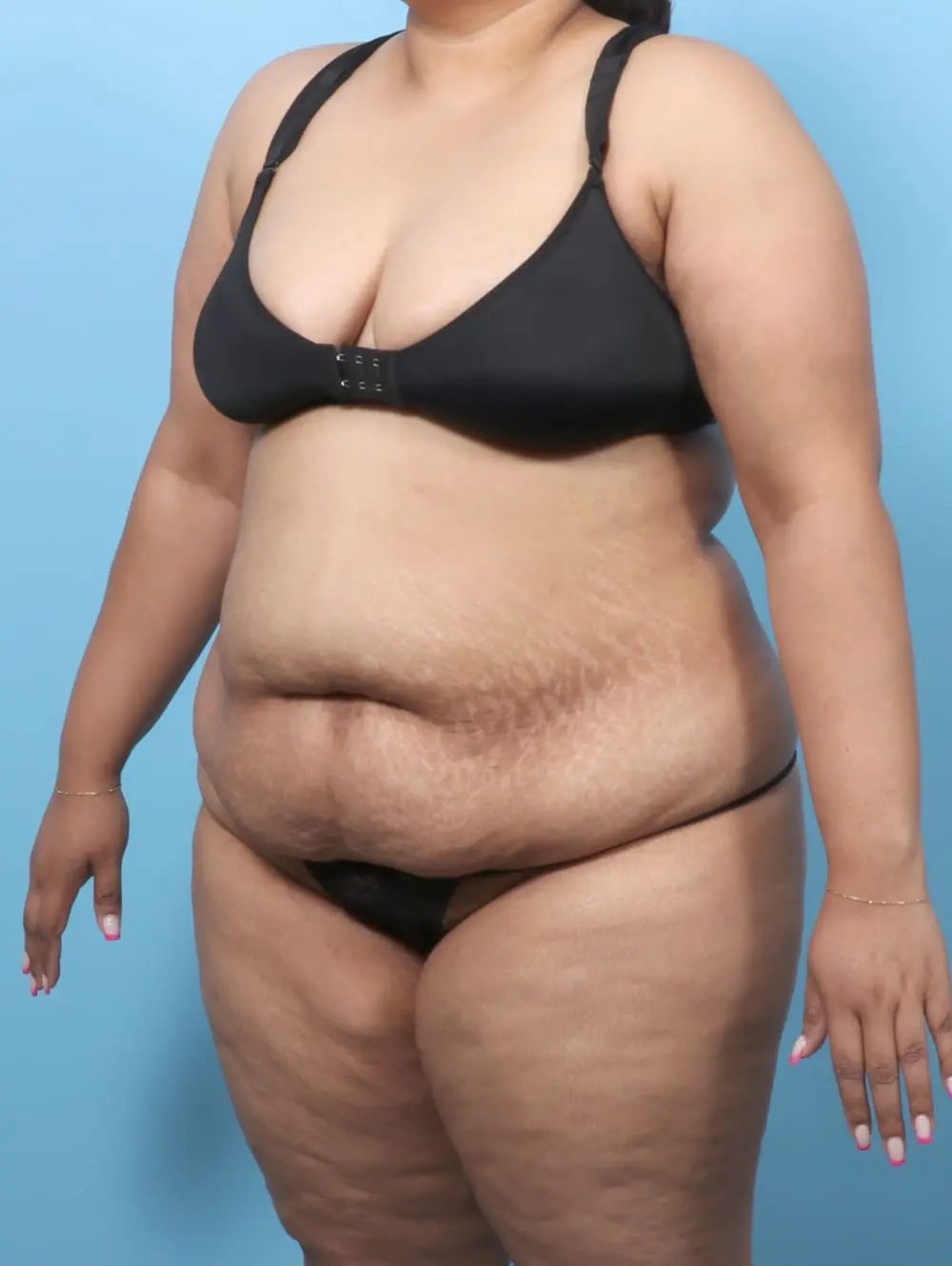 Tummy Tuck Patient Photo - Case 61909 - before view-1