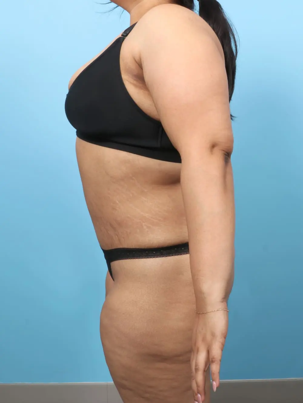 Tummy Tuck Patient Photo - Case 61909 - after view-2