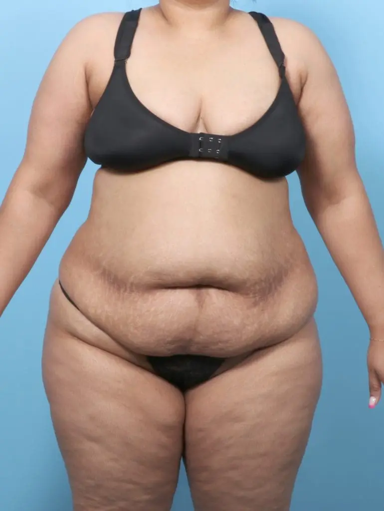 Tummy Tuck - Case 61909 - Before