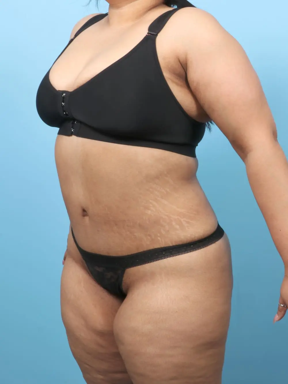 Tummy Tuck Patient Photo - Case 61909 - after view-1