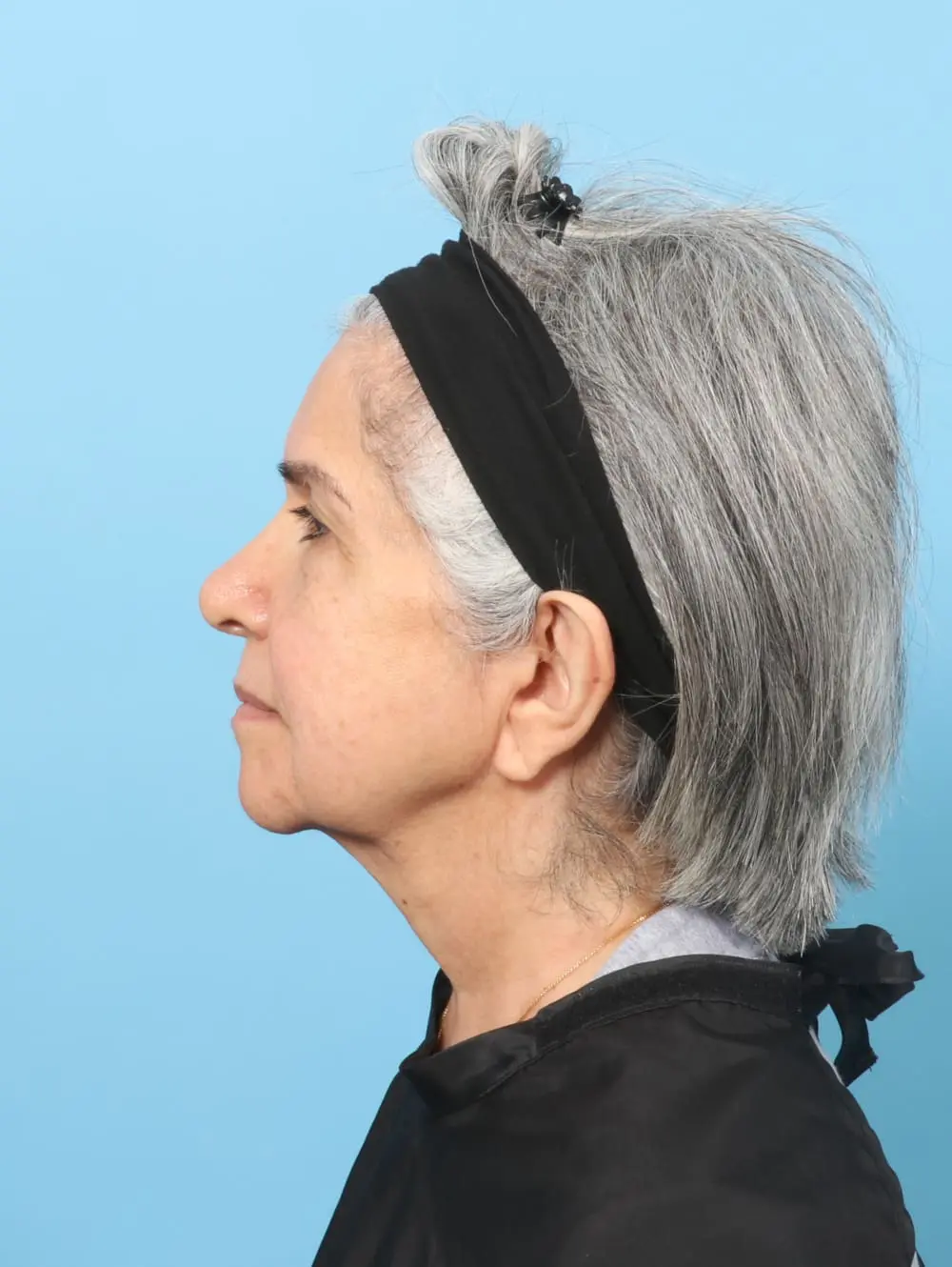 Facelift / Neck Lift Patient Photo - Case 61927 - before view-2