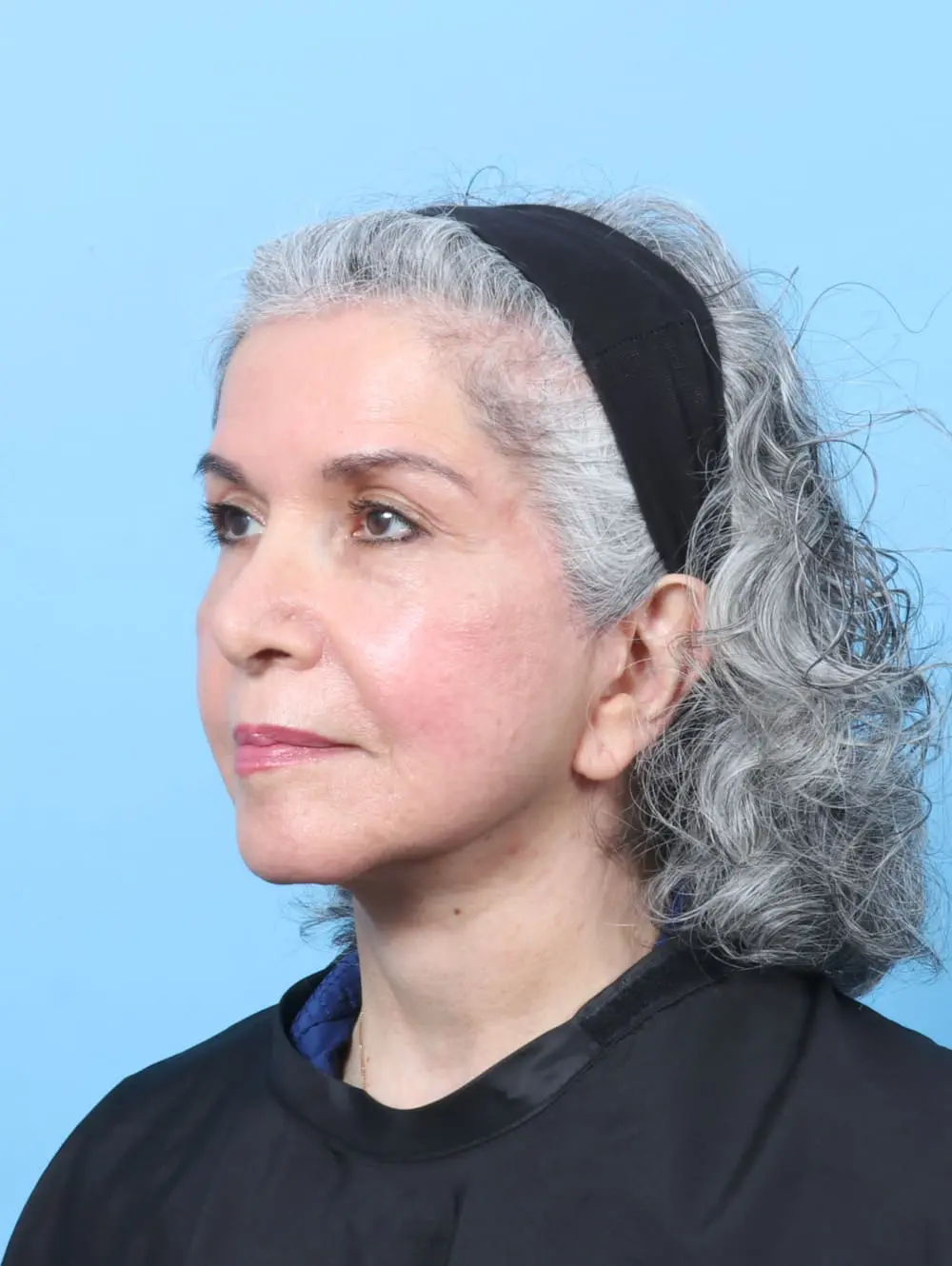 Facelift / Neck Lift Patient Photo - Case 61927 - after view-1