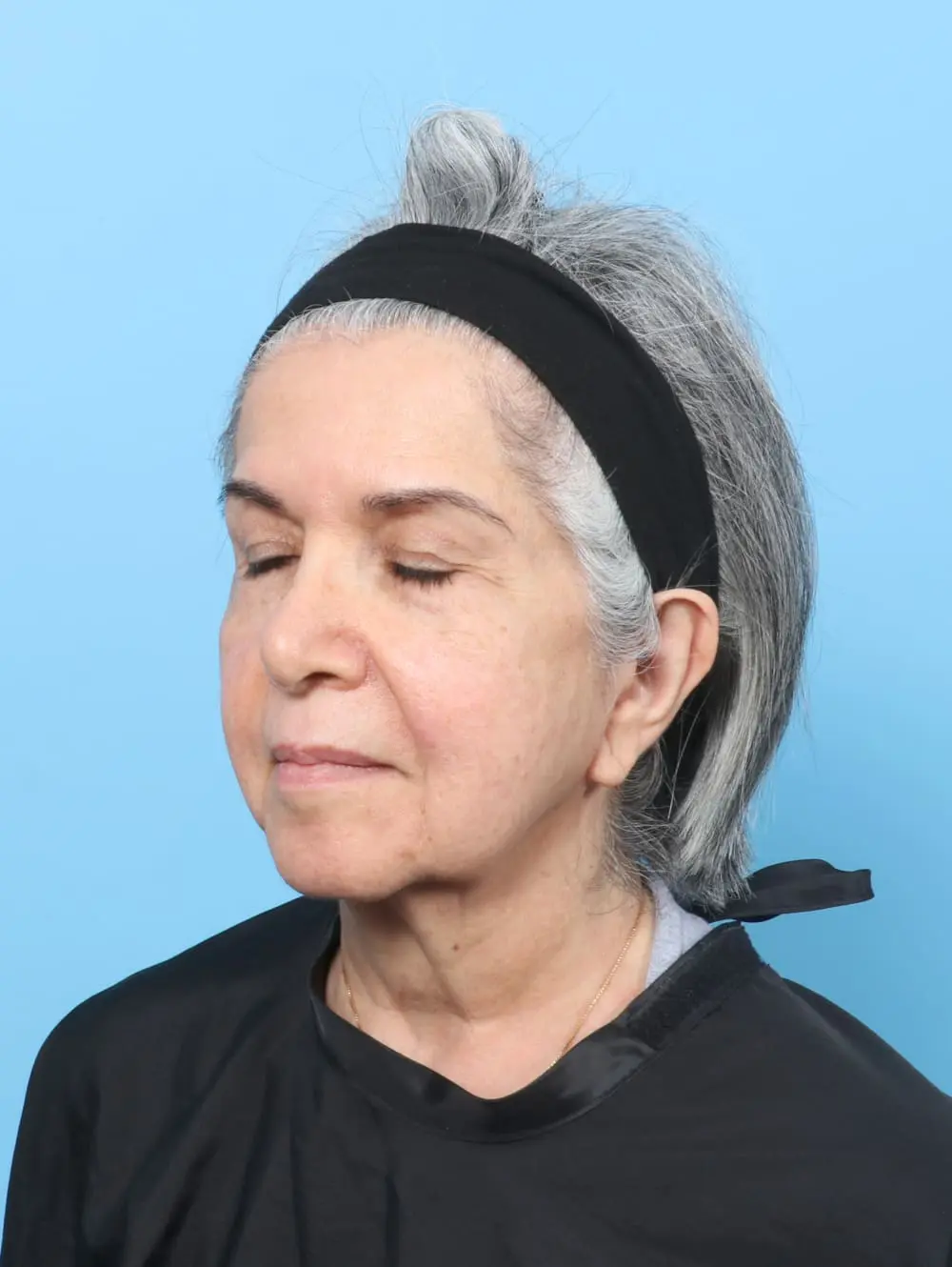 Facelift / Neck Lift Patient Photo - Case 61927 - before view-1