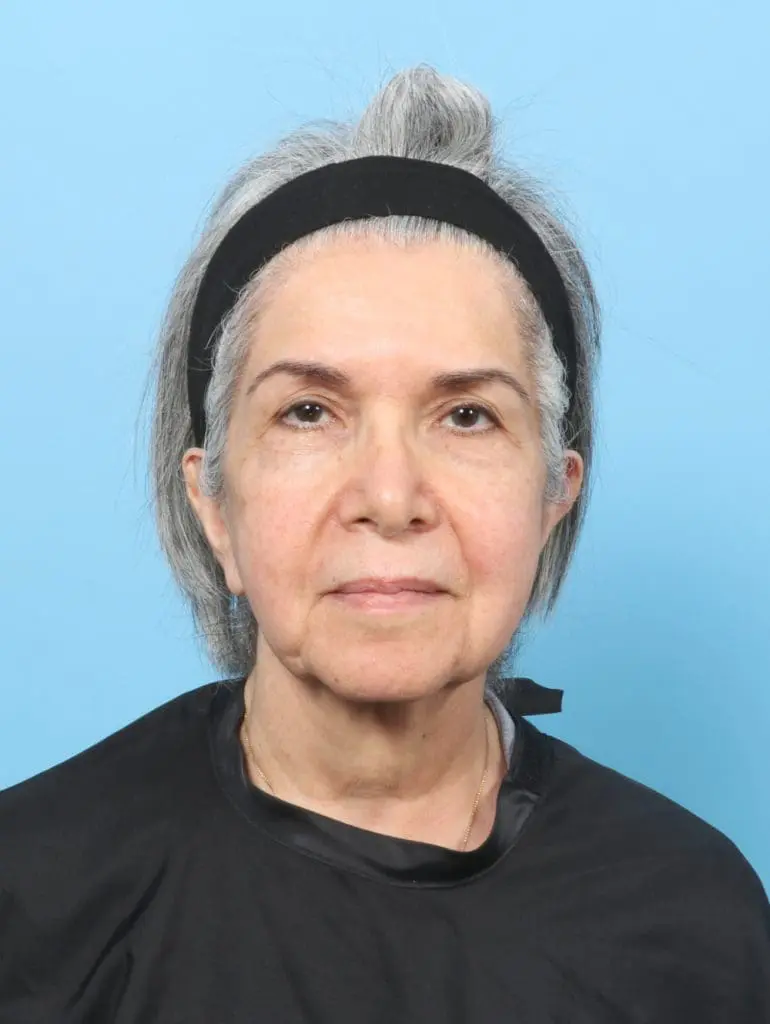 Facelift / Neck Lift - Case 61927 - Before