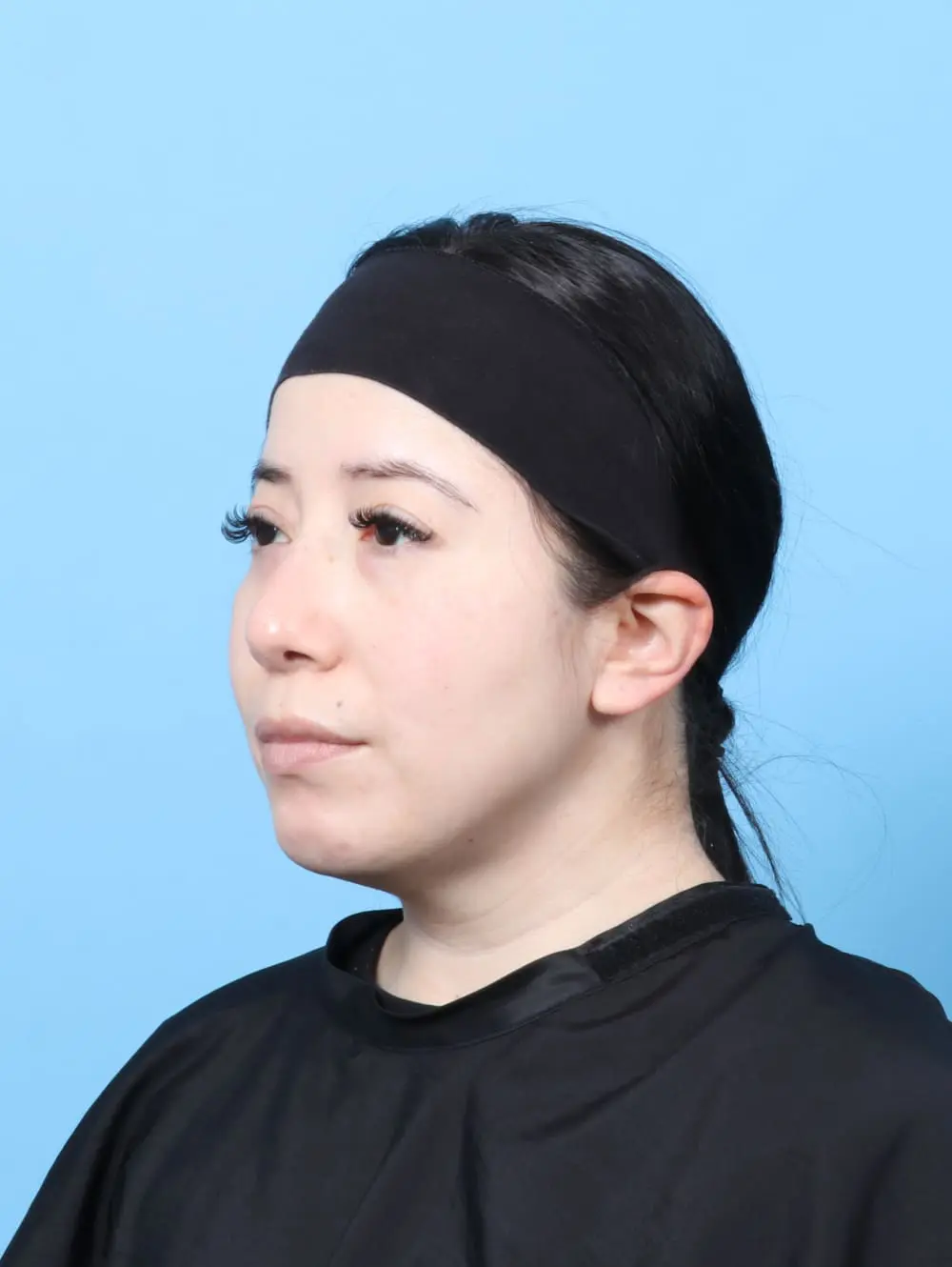Rhinoplasty Patient Photo - Case 61937 - after view-1