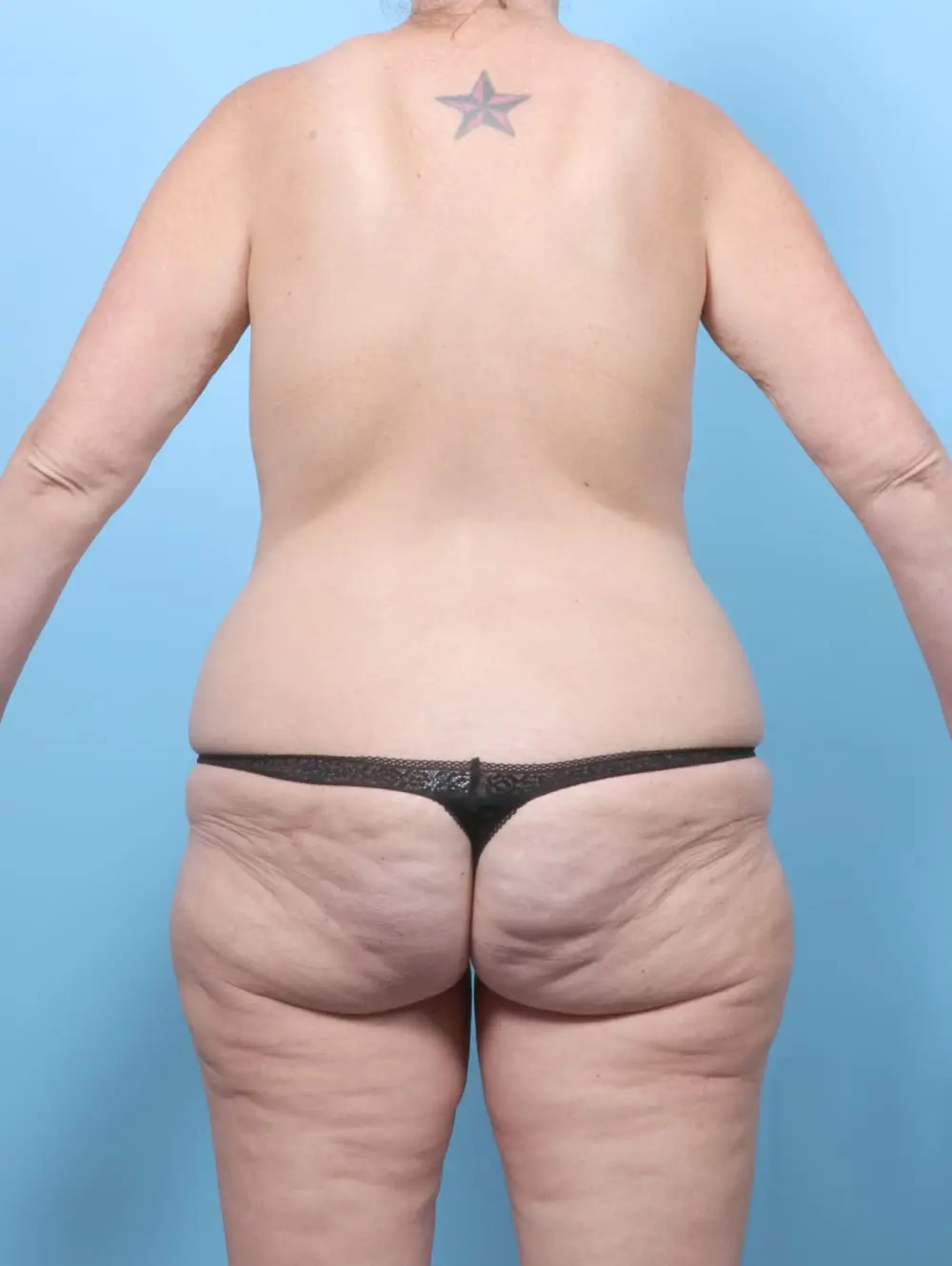 After Weight Loss Patient Photo - Case 61978 - before view-3