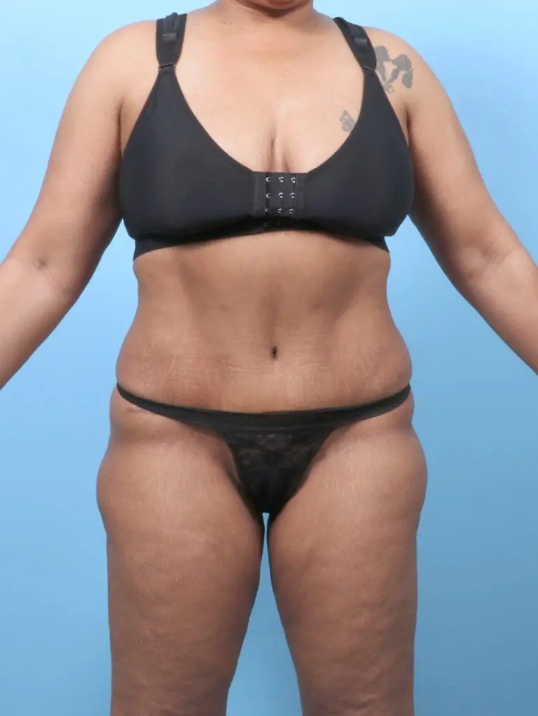 Tummy Tuck - Case 62099 - After