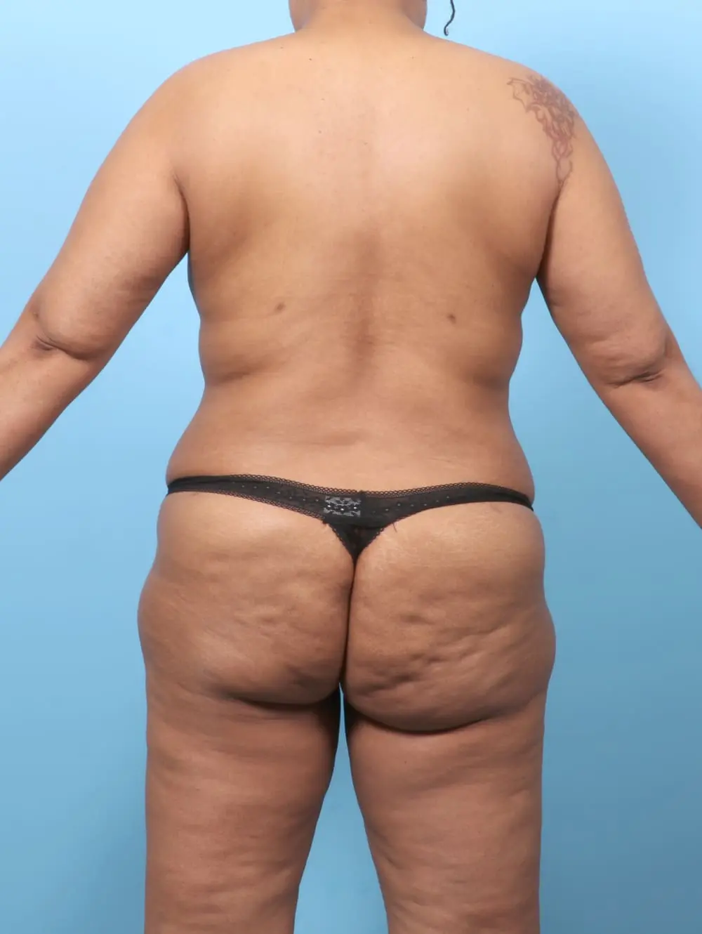 Tummy Tuck Patient Photo - Case 62099 - after view-3
