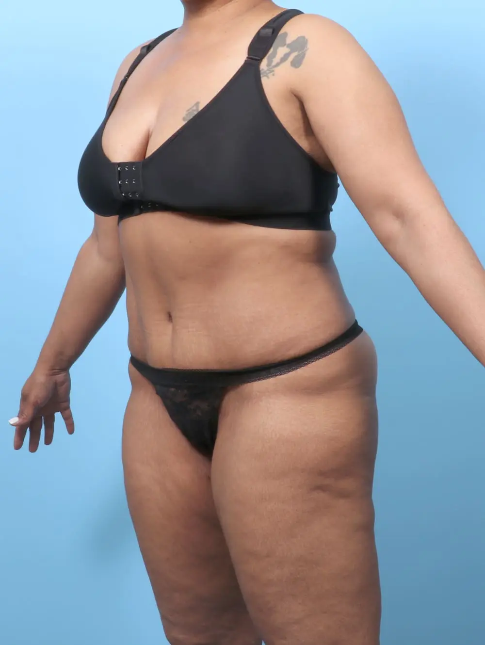 Tummy Tuck Patient Photo - Case 62099 - after view-1