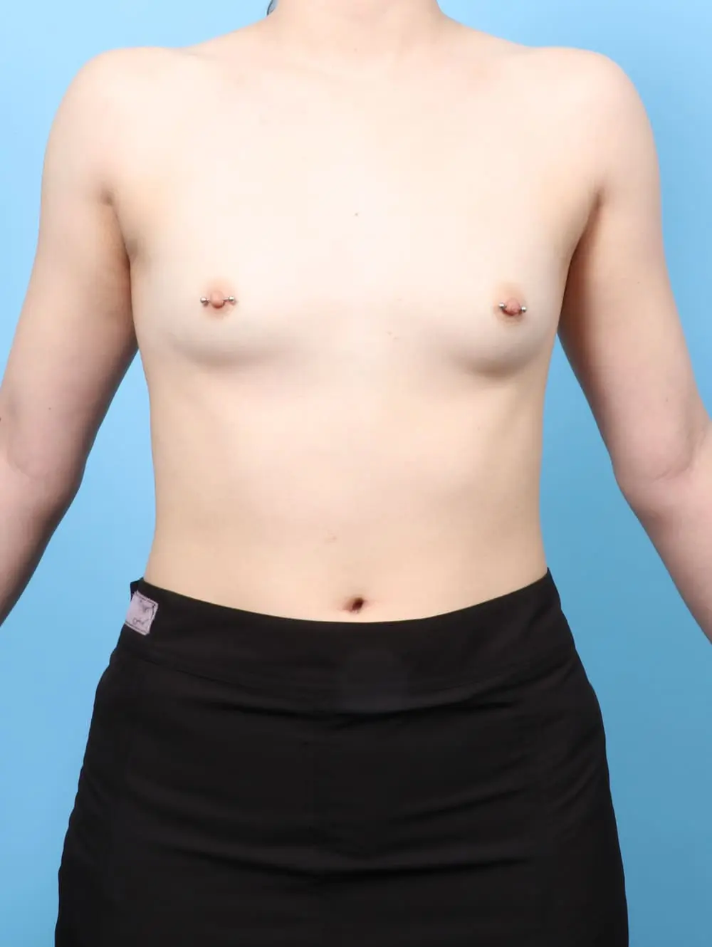 Breast Augmentation Patient Photo - Case 62110 - before view-