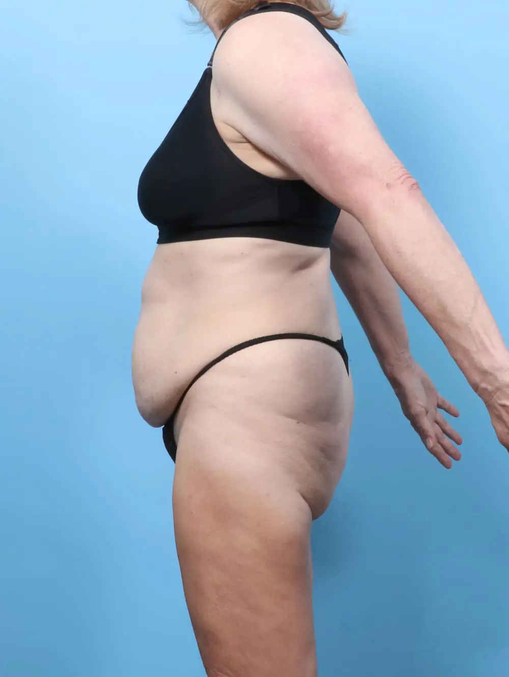Tummy Tuck Patient Photo - Case 62157 - before view-2
