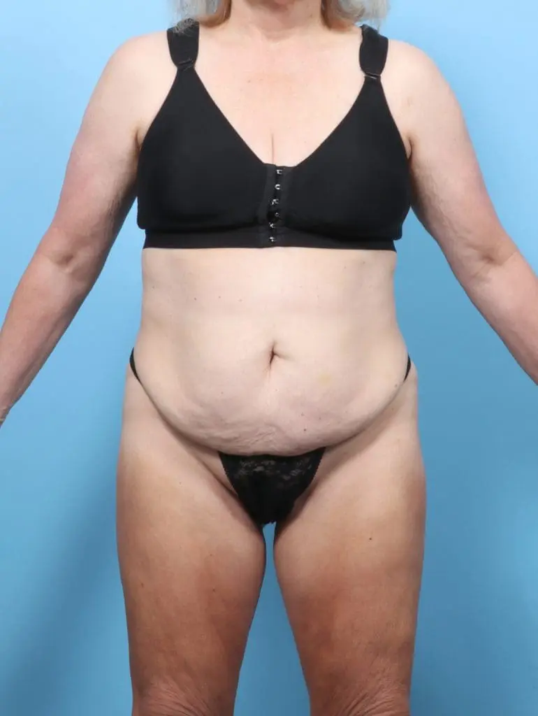 Tummy Tuck - Case 62157 - Before