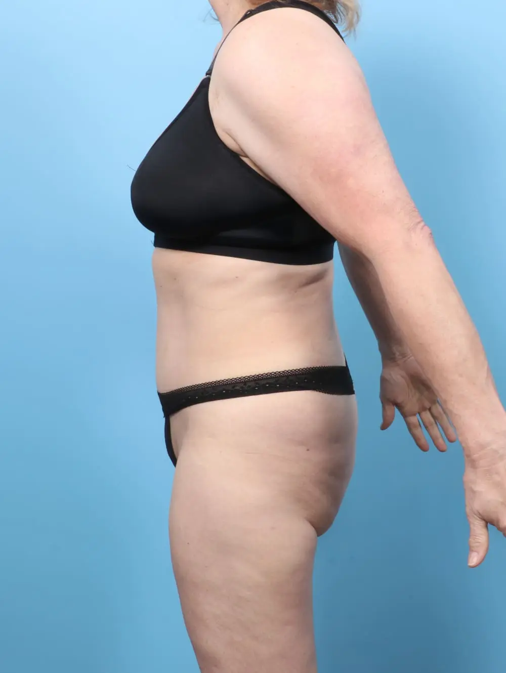Tummy Tuck Patient Photo - Case 62157 - after view-2