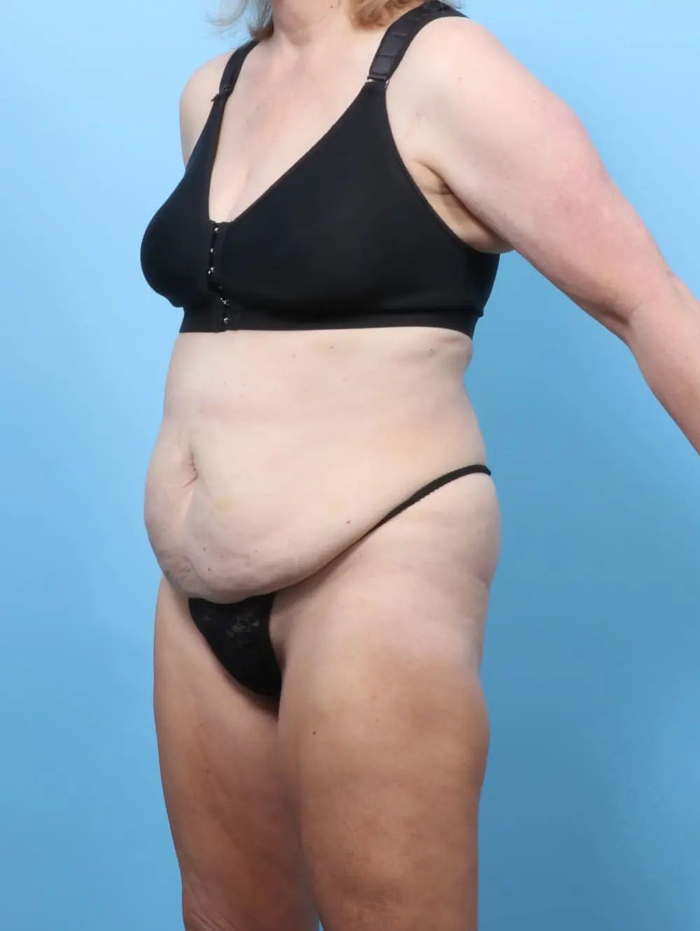 Tummy Tuck Patient Photo - Case 62157 - before view-1