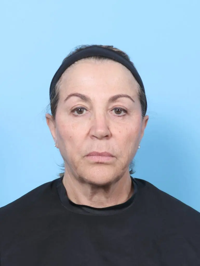 Facelift / Neck Lift - Case 62173 - Before