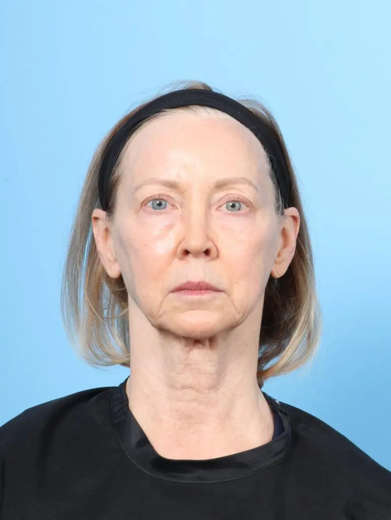 Facelift / Neck Lift - Case 62183 - Before