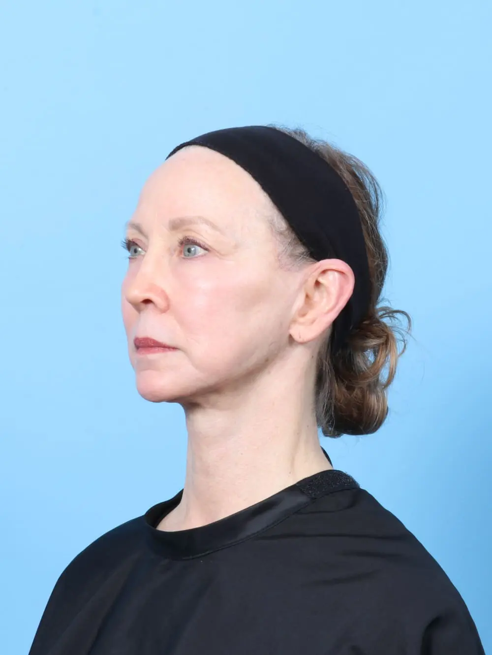 Facelift / Neck Lift Patient Photo - Case 62183 - after view-1