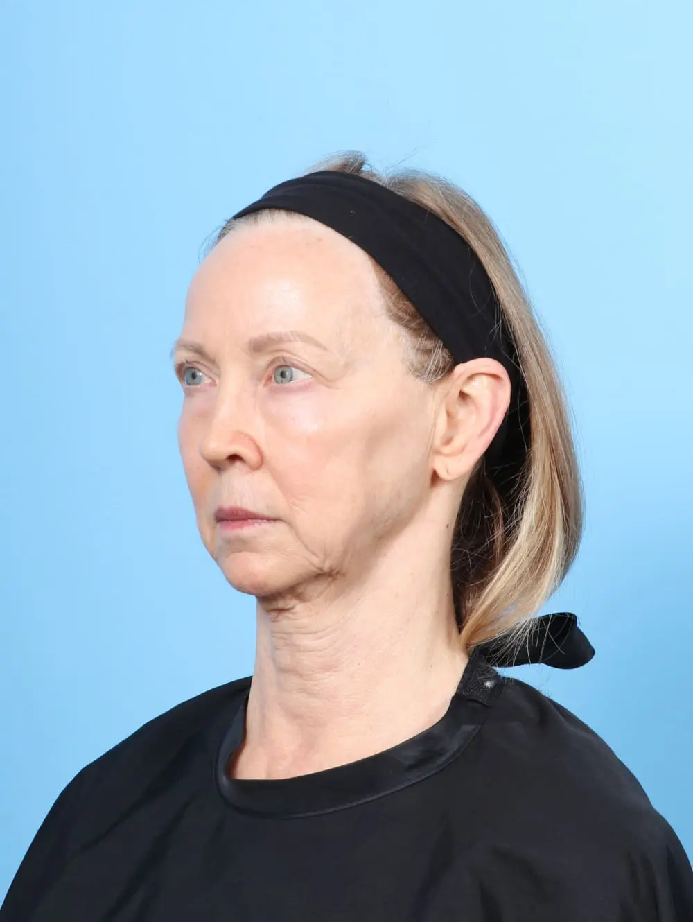 Facelift / Neck Lift Patient Photo - Case 62183 - before view-1
